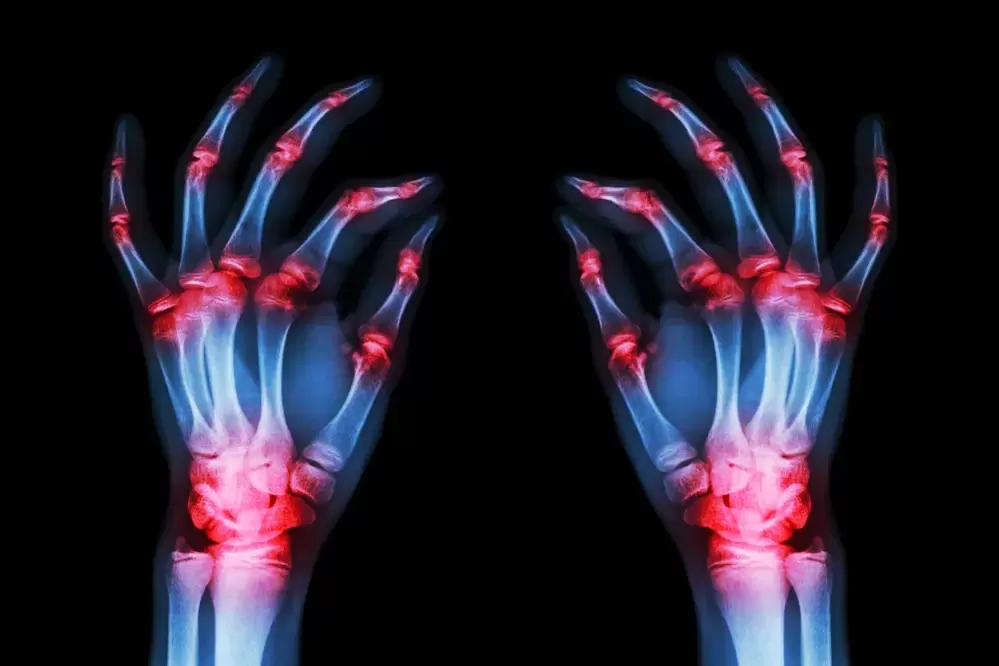 artrose van de vingergewrichten