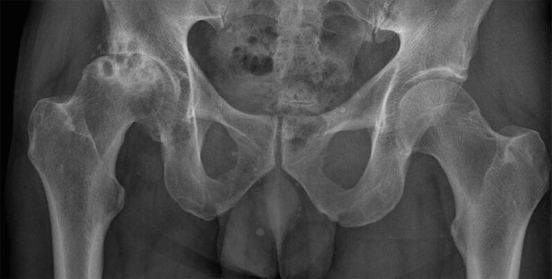 Stadium 3 artrose van het heupgewricht op röntgenfoto