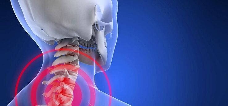 Osteochondrose van het cervicale gebied