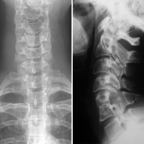 X -Ray van de cervicale wervelkolom
