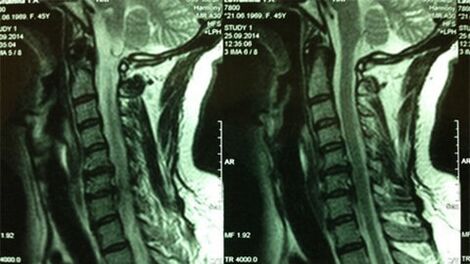MRI van de cervicale afdeling