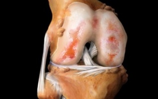 wat is artrose van het kniegewricht