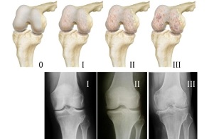 methoden voor het diagnosticeren van artrose van de knie