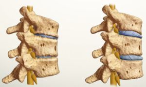 hoe ziet osteochondrose eruit