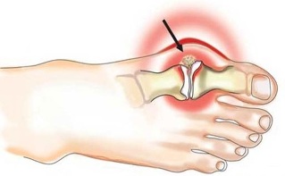 Ontsteking van het gewricht tussen duim en voet bij artritis