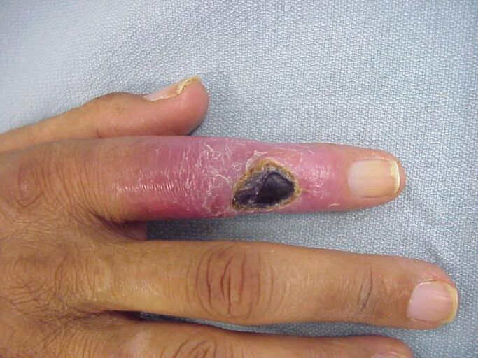 osteomyelitis als oorzaak van pijn in de gewrichten van de vingers
