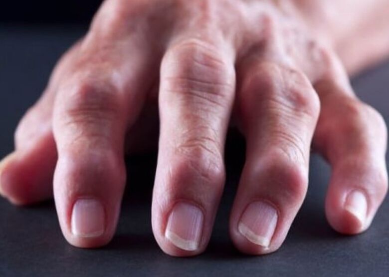 reumatoïde artritis als oorzaak van pijn in de gewrichten van de vingers