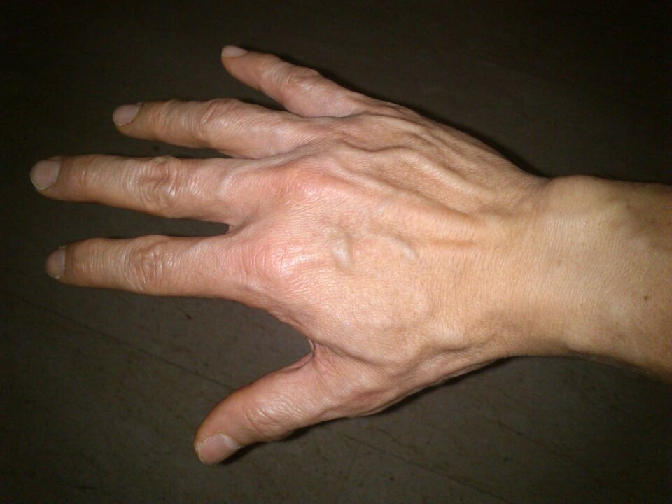 vervorming van botten en pijn in de gewrichten van de vingers