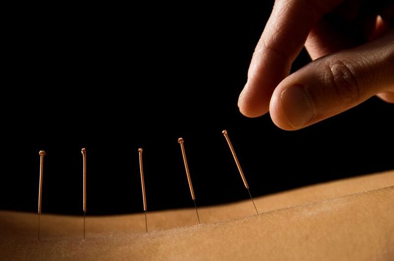 acupunctuur voor rugpijn